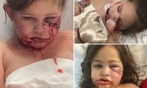 3-year-old Louisiana girl can no longer smile after dog bite